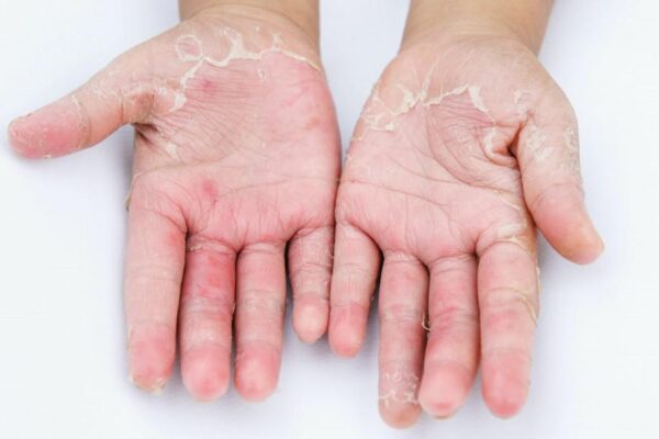 17645936201764593606968contact-dermatitis-600x400-1.jpg